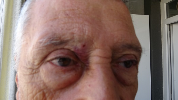 Neye uğradığını şaşırdı! Yaşlı adamın kaşına saçma isabet etti