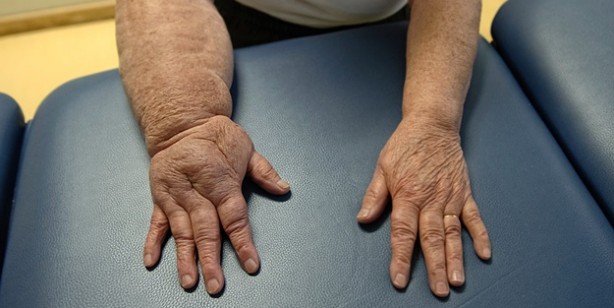 Foto - Ödeme iyi gelen 10 besin