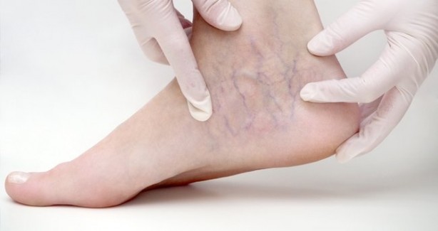 Ödeme iyi gelen 10 besin