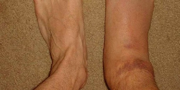 Foto - Ödeme iyi gelen 10 besin