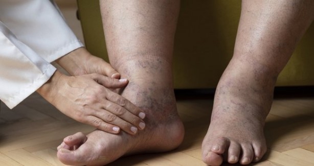 Foto - Ödeme iyi gelen 10 besin