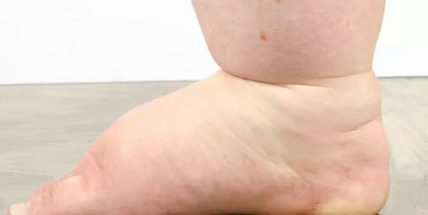 Foto - Ödeme iyi gelen 10 besin