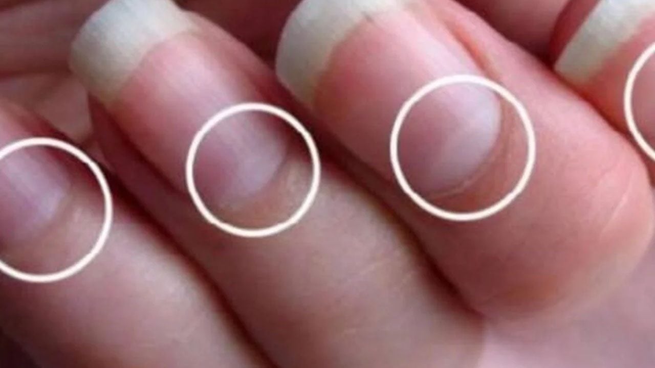 Foto - Tırnak diplerine dikkat! Eğer öyleyse bakın hangi hastalıkların habercisiymiş…