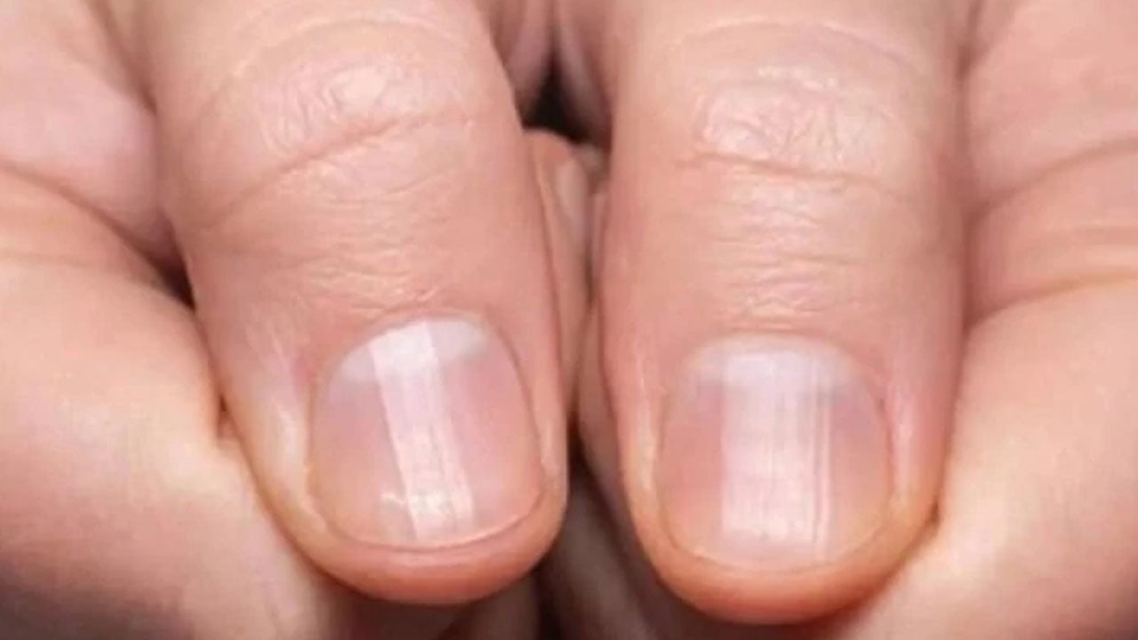 Foto - Tırnak diplerine dikkat! Eğer öyleyse bakın hangi hastalıkların habercisiymiş…