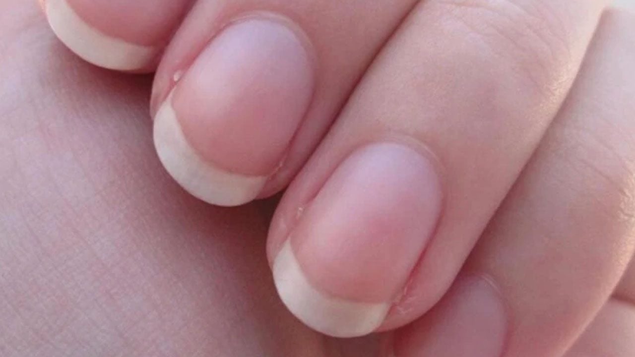 Foto - Tırnak diplerine dikkat! Eğer öyleyse bakın hangi hastalıkların habercisiymiş…