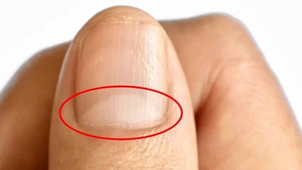 Foto - Tırnak diplerine dikkat! Eğer öyleyse bakın hangi hastalıkların habercisiymiş…