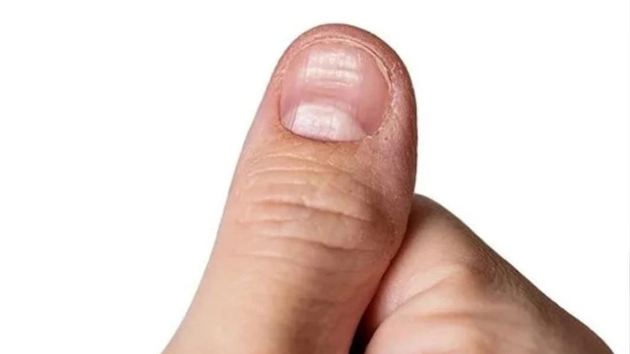 Foto - Tırnak diplerine dikkat! Eğer öyleyse bakın hangi hastalıkların habercisiymiş…
