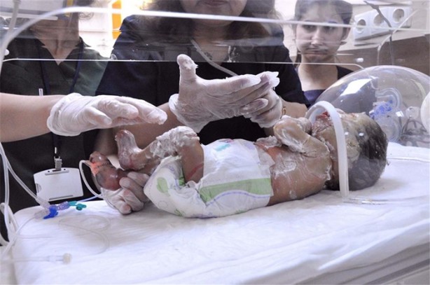 'Palyaço bebek' yaşam savaşı veriyor