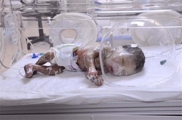 Foto - 'Palyaço bebek' yaşam savaşı veriyor