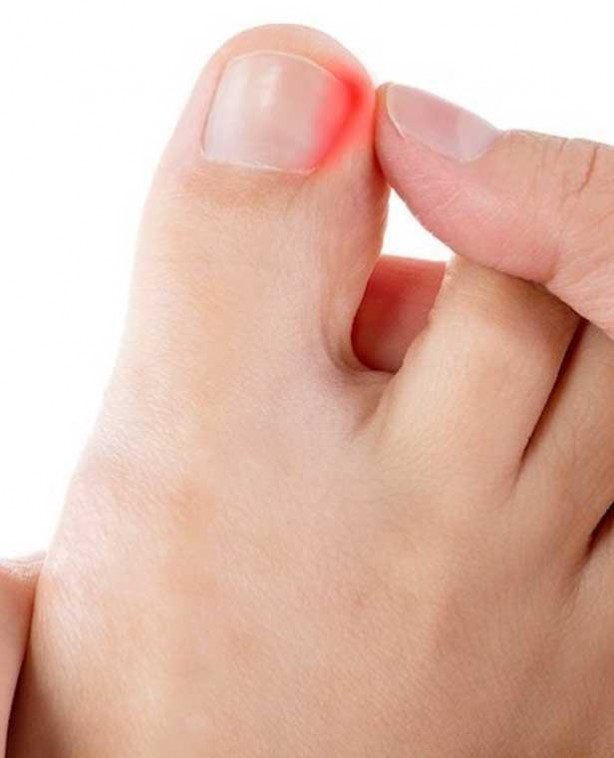 Pamuk işi çözüyor! Tırnak batmasına karşı sır gibi saklanan çözümler!