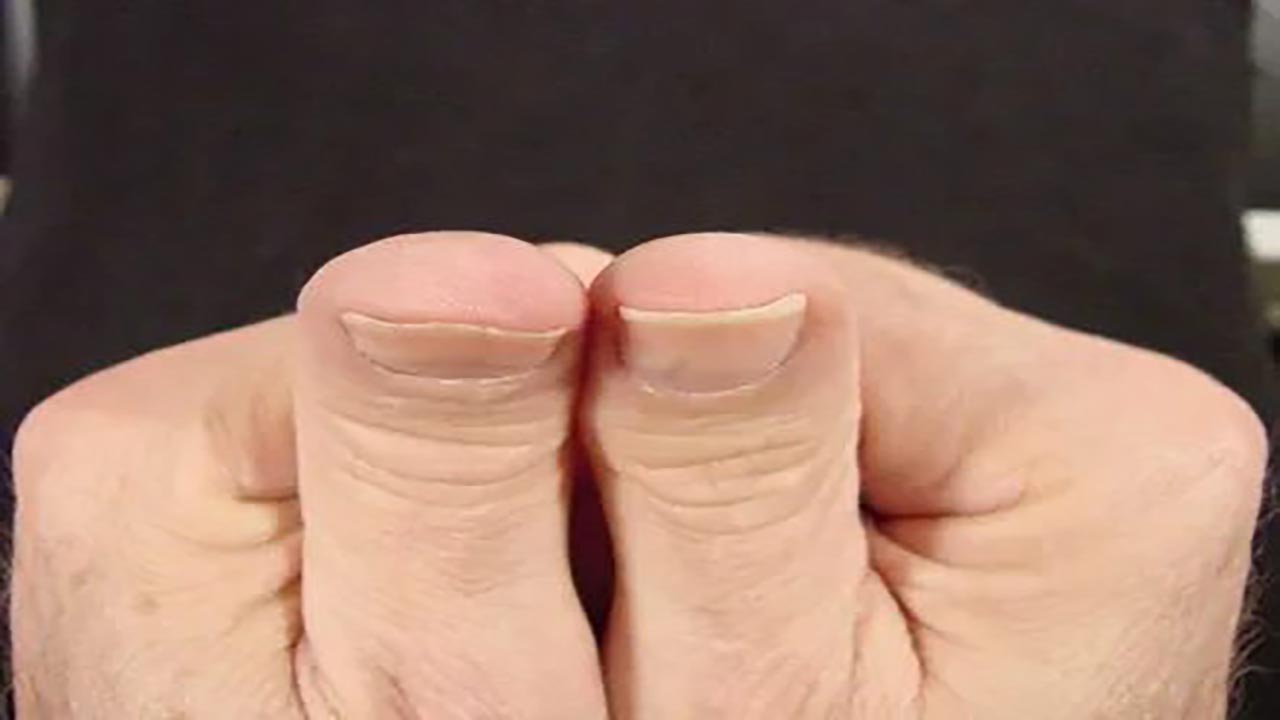 Foto - Parmaklarınızı hemen kontrol edin! Akciğer kanseri parmaktan anlaşılabiliyor