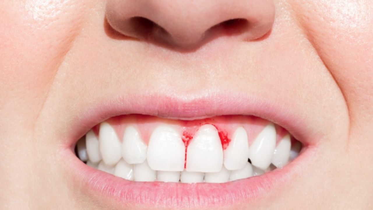 Periodontal hastalıklar, diyabet ve solunum... Diş eti kanaması sistemik hastalıkların habercisi olabilir