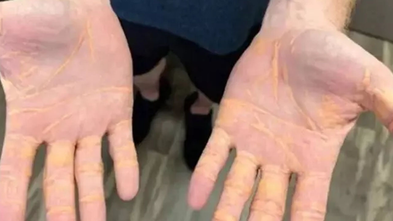 Foto - Etobur Diyeti nedir? Popüler diyet onu bakın ne hale getirdi!: Başına bela oldu! Kansere bile yol açabilir 