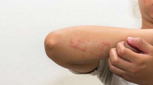 Foto - Primer İmmün Yetmezliği'nin belirtileri