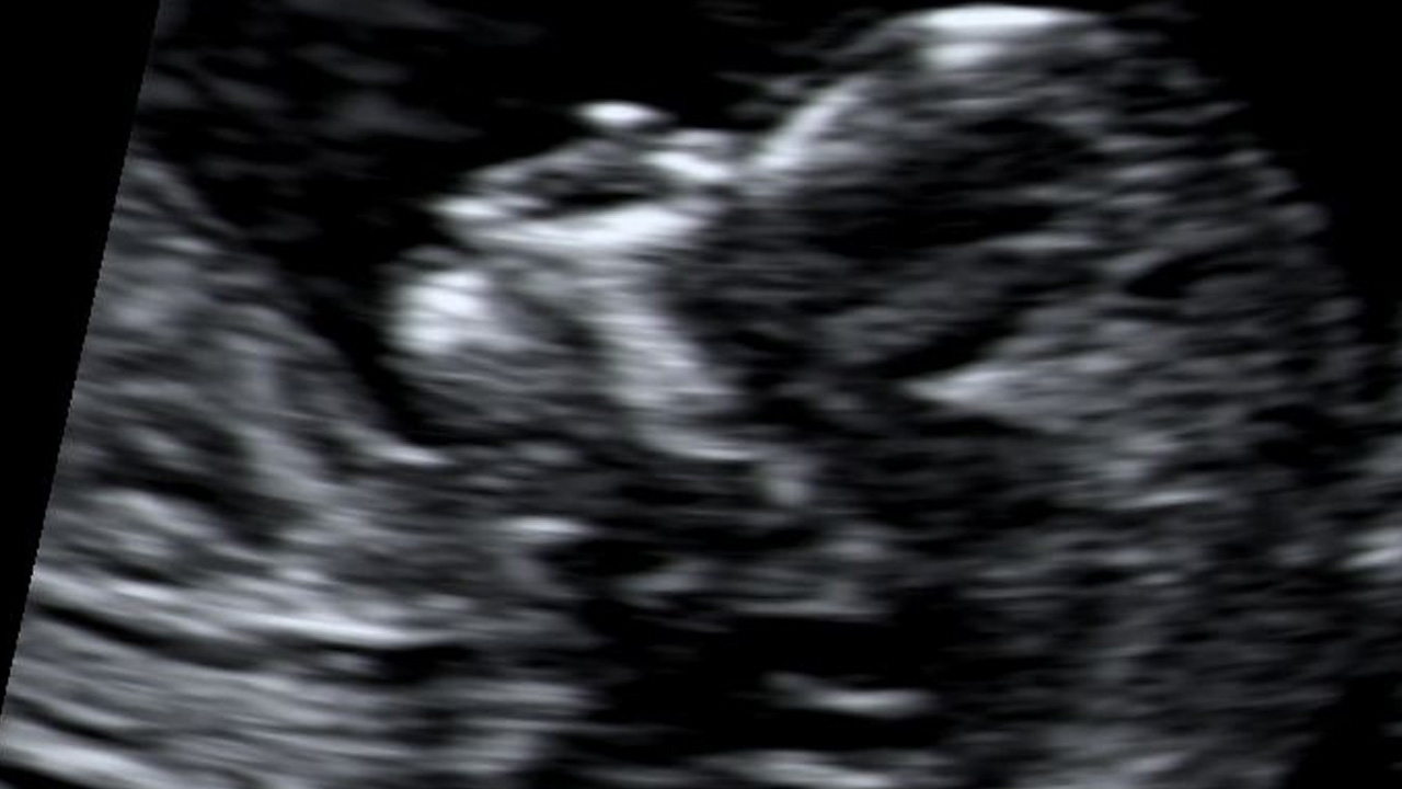 Prof. Dr. Topgül: Şişkinlik sanılan şey kitle olabilir! Bu işarete dikkat...İşte o belirtisini duyurdu