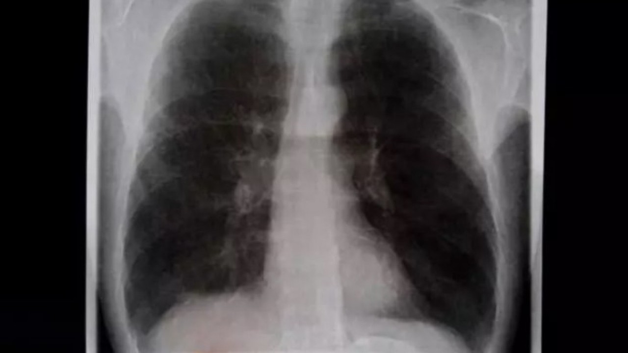 Foto - Profesörden kadınlara uyarı: 10 yıl içinde hızla artacak