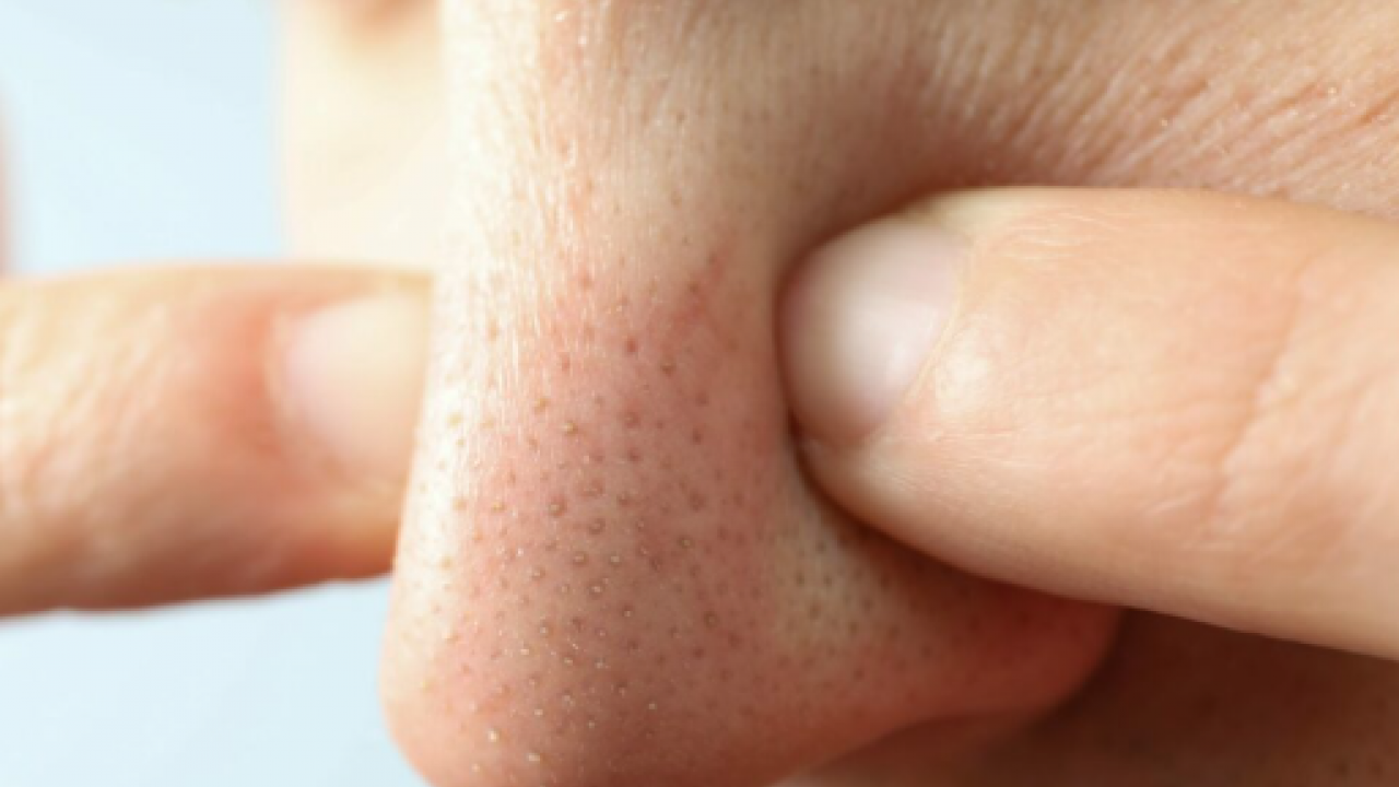 Pürüzsüz bir cilde sahip olabilirsiniz! İşte siyah noktalardan kurtulmanın doğal yolu