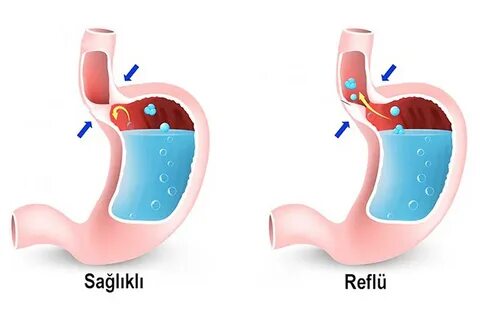 Foto - Reflüsü olanlara uzman uyarısı! Bu belirtileri olanlar dikkat