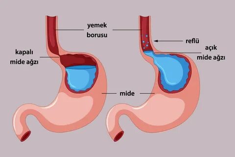 Foto - Reflüsü olanlara uzman uyarısı! Bu belirtileri olanlar dikkat