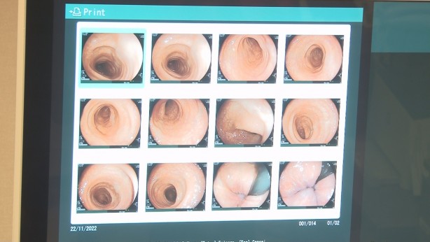 Reflüsü olanlara uzman uyarısı! Bu belirtileri olanlar dikkat