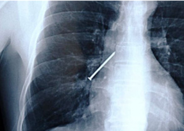 Foto - Röntgen sonrası çıkanlar doktorları bile şok etti! İşte açıklanamayan o görüntüler