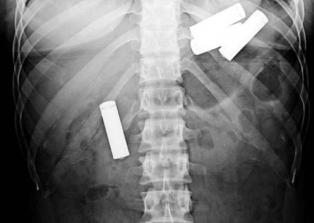 Foto - Röntgen sonrası çıkanlar doktorları bile şok etti! İşte açıklanamayan o görüntüler