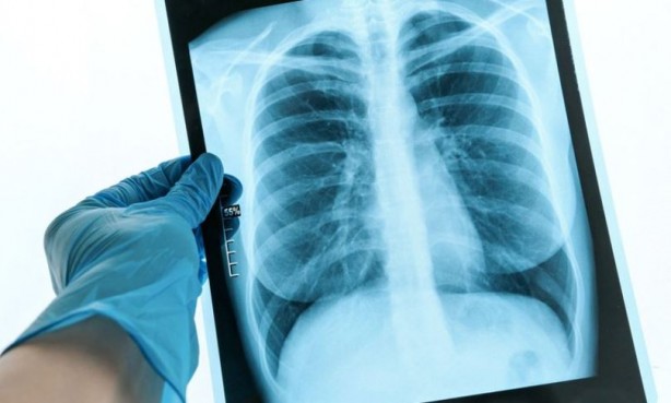 Foto - Sabah saatlerinde bu belirtiler kanser habercisi