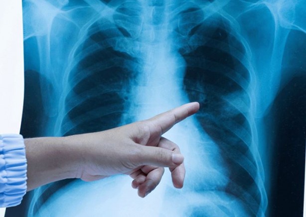 Foto - Sabah saatlerinde bu belirtiler kanser habercisi