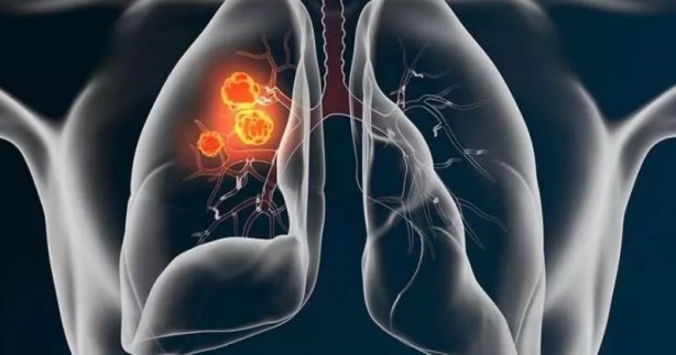 Foto - Sabah saatlerinde bu belirtiler kanser habercisi