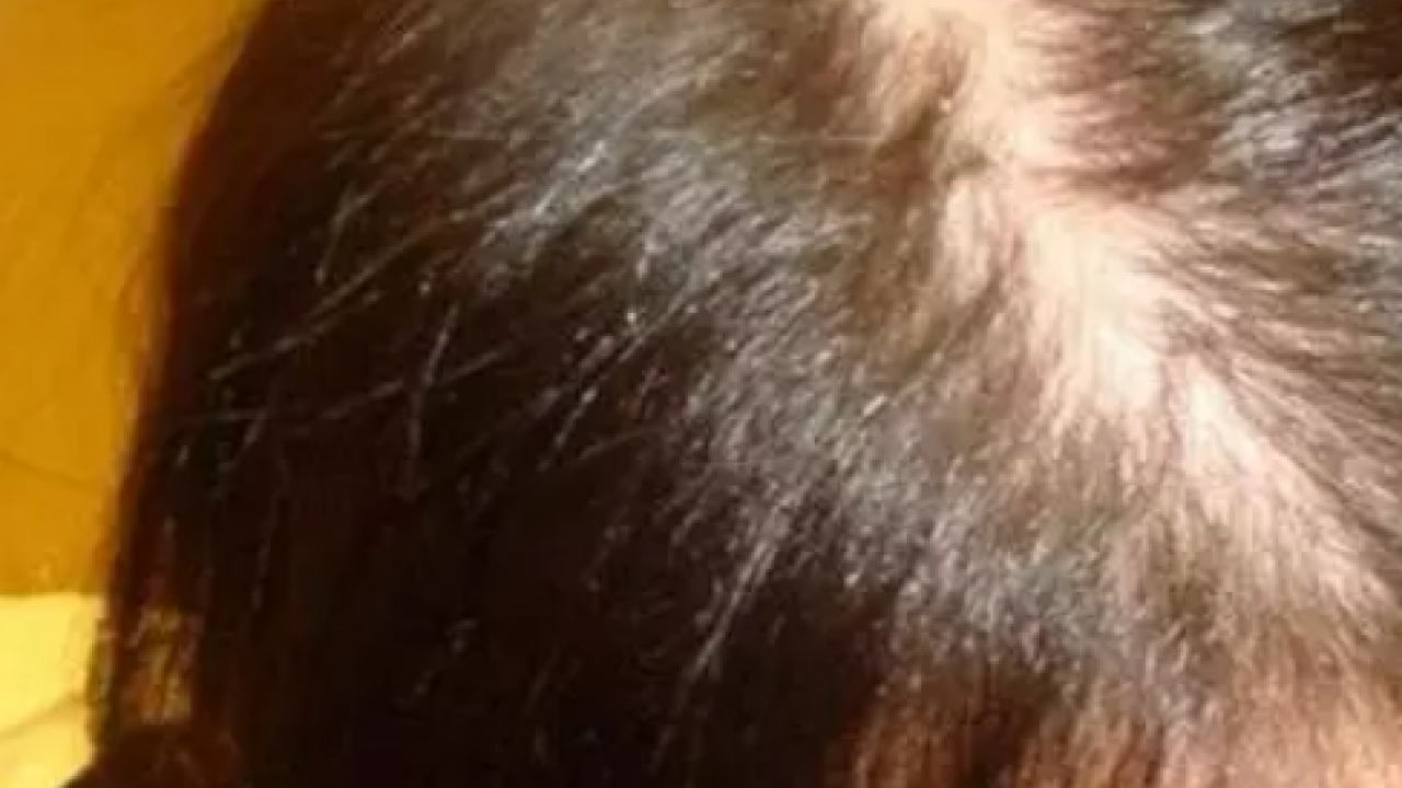 Foto - Saç diplerindeki egzama, kepek ve kaşıntının çaresi! Çözümü son derece kolay: 1 damlası kafa derisini rahatlatıyor