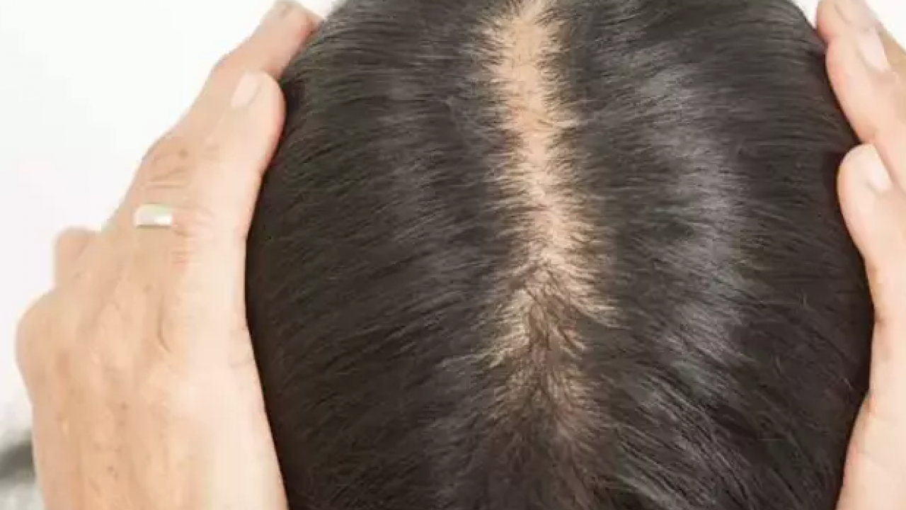 Foto - Saç diplerindeki egzama, kepek ve kaşıntının çaresi! Çözümü son derece kolay: 1 damlası kafa derisini rahatlatıyor