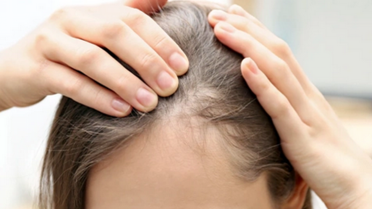 Foto - Saç diplerindeki egzama, kepek ve kaşıntının çaresi! Çözümü son derece kolay: 1 damlası kafa derisini rahatlatıyor