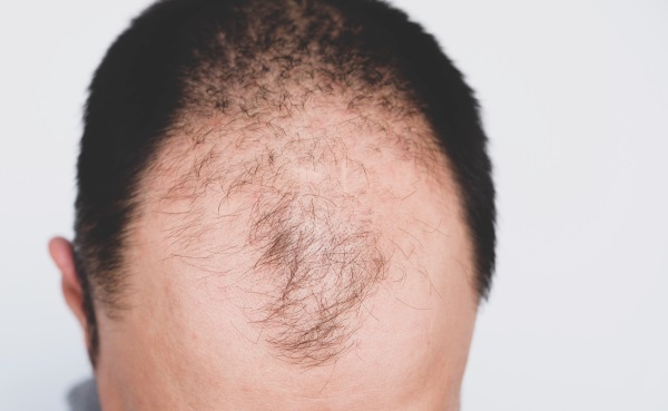 Foto - Saç dökülmesi kabusunuz olmasın! İşte saçlarınızı kurtarmanın formülü