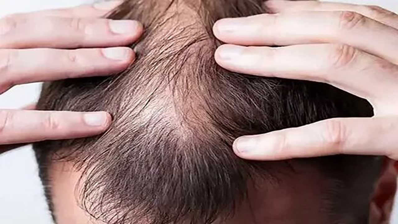 Foto - Saç dökülmesinde ezber bozan sonuçlar: Kelliğe karşı ilaç bulundu, raporlar olumlu...
