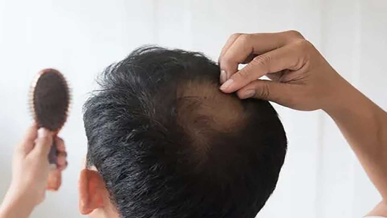 Foto - Saç dökülmesinde ezber bozan sonuçlar: Kelliğe karşı ilaç bulundu, raporlar olumlu...