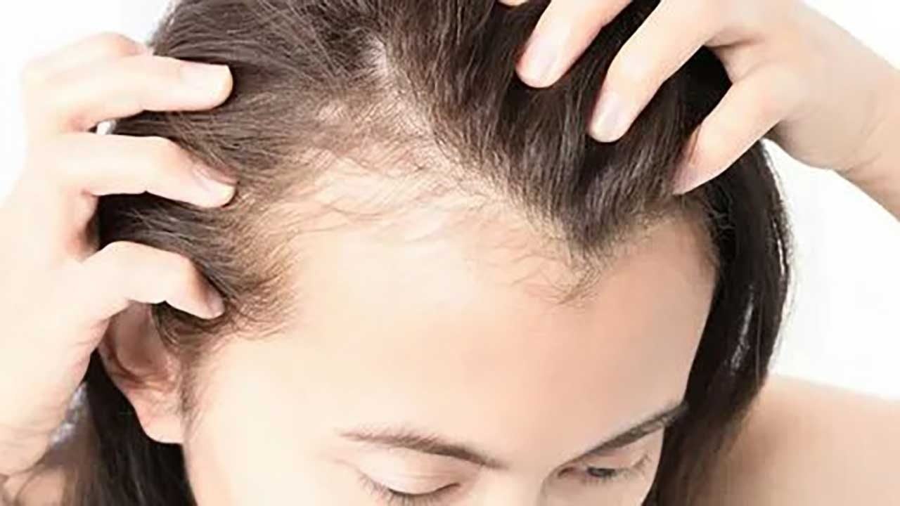 Foto - Saç dökülmesinde ezber bozan sonuçlar: Kelliğe karşı ilaç bulundu, raporlar olumlu...