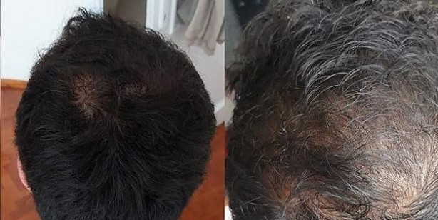 Foto - Saç dökülmesinden karanfil kürü yaparak kurtulun