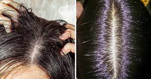 Foto - Saç dökülmesine bitkisel çözüm! Bunları yapın: Saç fışkırtıyor! Saç derisi bariyerini onaran yöntem!