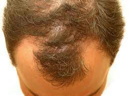 Foto - Saç dökülmesine evde doğal ve bitkisel çözüm: Saçı kökünden çoşturan lavanta suyu bakın ne işe yarıyor!