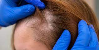 Foto - Saç dökülmesine evde doğal ve bitkisel çözüm: Saçı kökünden çoşturan lavanta suyu bakın ne işe yarıyor!