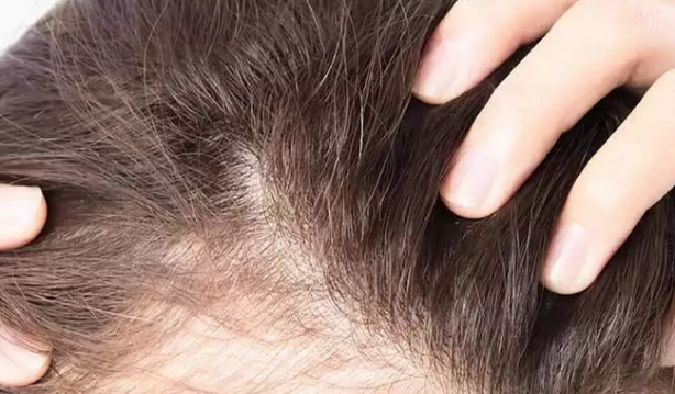 Foto - Saç dökülmesine iyi gelen 10 mükemmel yöntem: Eşi benzeri olmayan bir uygulama saçlara adeta can verdi!