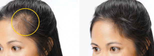 Saç dökülmesine iyi gelen 10 mükemmel yöntem: Eşi benzeri olmayan bir uygulama saçlara adeta can verdi!