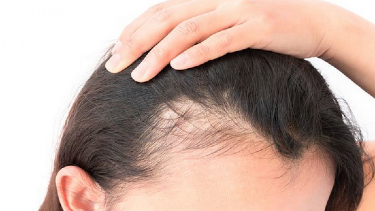 Saç dökülmesine karşı 5 gıda: Çok güçlü besinler büyük değişim yapıyor, herkes şokta! Tercih ediliyor