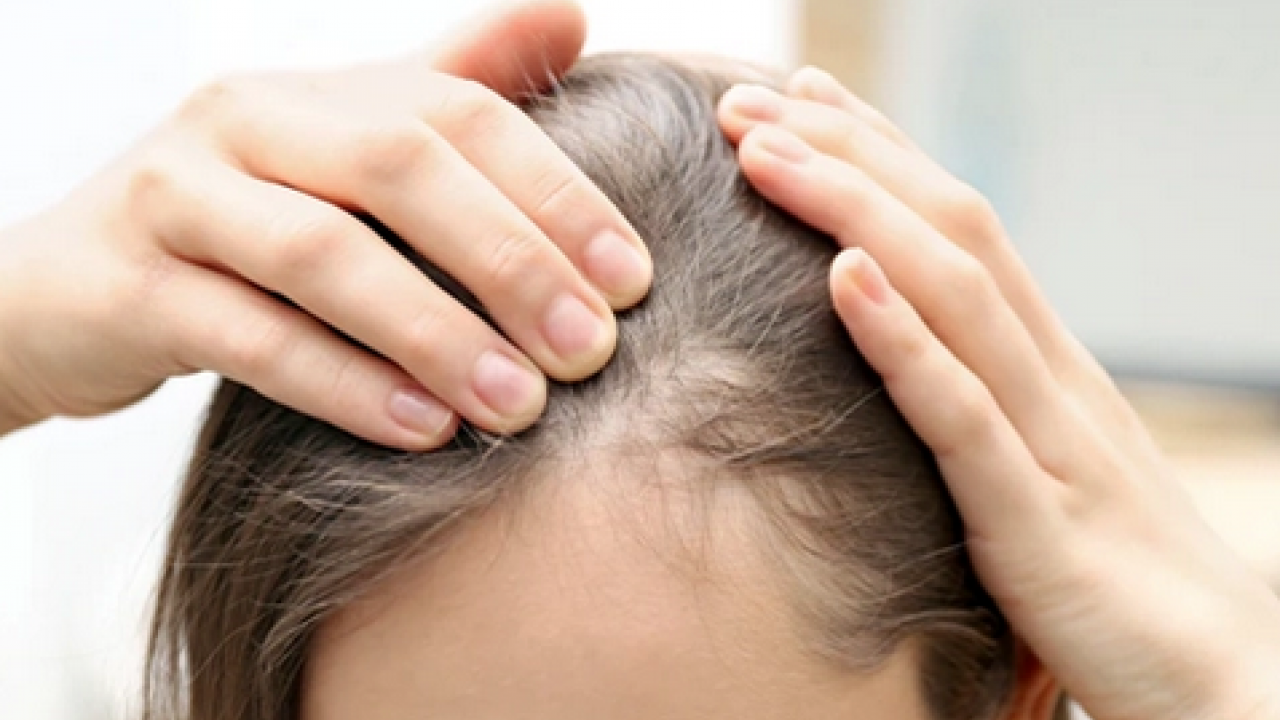 Foto - Saç dökülmesine karşı 5 gıda: Çok güçlü besinler büyük değişim yapıyor, herkes şokta! Tercih ediliyor