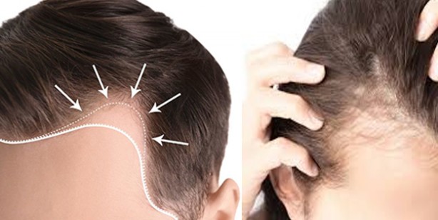 Foto - Saç dökülmesine ne iyi gelir? Bu yiyecek saç dökülmesini anında durduruyor! Durmayan saç dökülmesine etkili doğal yöntem