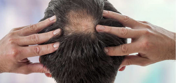 Foto - Saç dökülmesine yüzde yüz son: Saç her yerden fışkıracak! Birçok yağı bu sebeple satın alıyorlar!