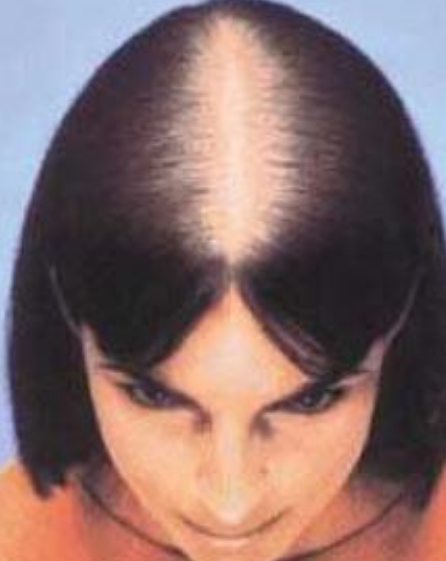 Saç dökülmesine yüzde yüz son: Saç her yerden fışkıracak! Birçok yağı bu sebeple satın alıyorlar!