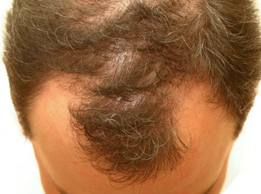 Foto - Saç dökülmesine yüzde yüz son: Saç her yerden fışkıracak! Birçok yağı bu sebeple satın alıyorlar!