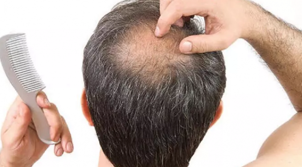 Foto - Saç dökülmesine yüzde yüz son: Saç her yerden fışkıracak! Birçok yağı bu sebeple satın alıyorlar!