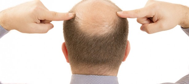 Foto - Saç dökülmesini azaltan 4 muhteşem yöntem